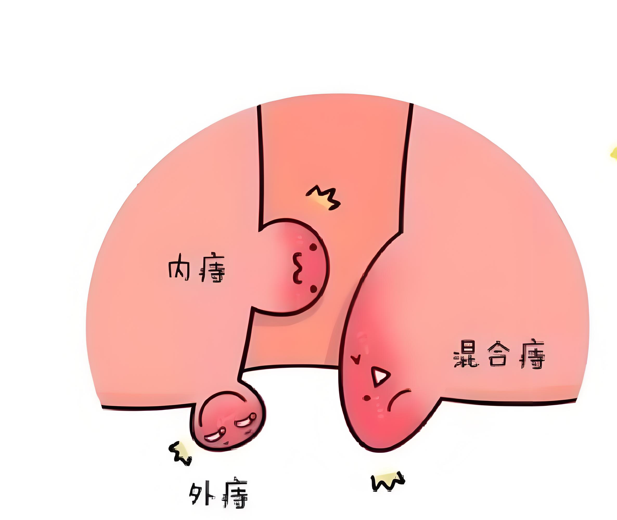 产后会不会出现痔疮问题？