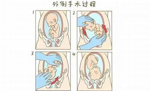 分娩前如何选择分娩方式?