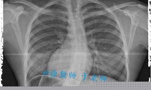 产后如何避免脊柱侧弯？