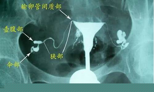 输卵管造影检查痛不痛？