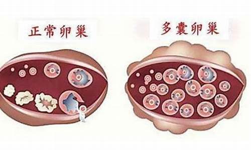 如何治疗多囊卵巢综合症导致的不孕？