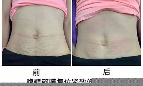 产后如何防止腹部皮肤裂纹？