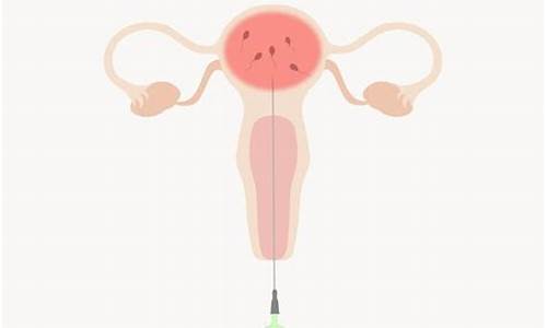 人工授精（IUI）适用于哪些人群？