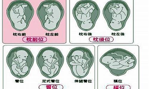 分娩时如果发生胎位不正,怎么办?